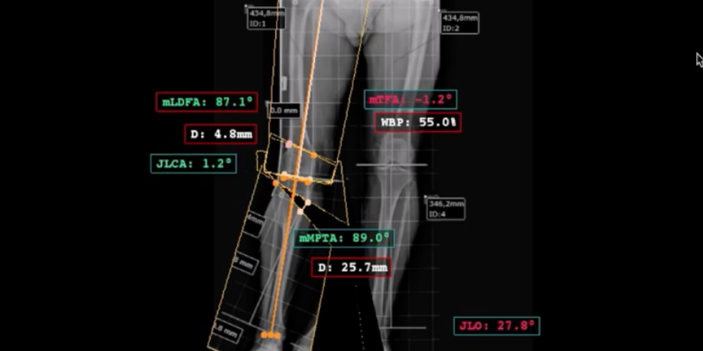 Knee Osteotomy アップデート Osteotomy.jpg